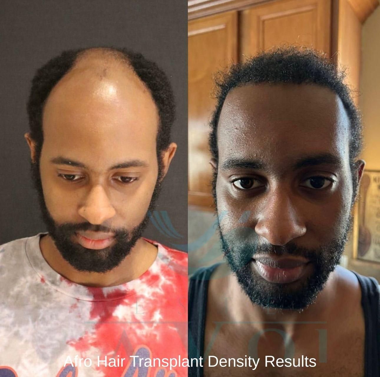 Afro Hair Transplant Density Results