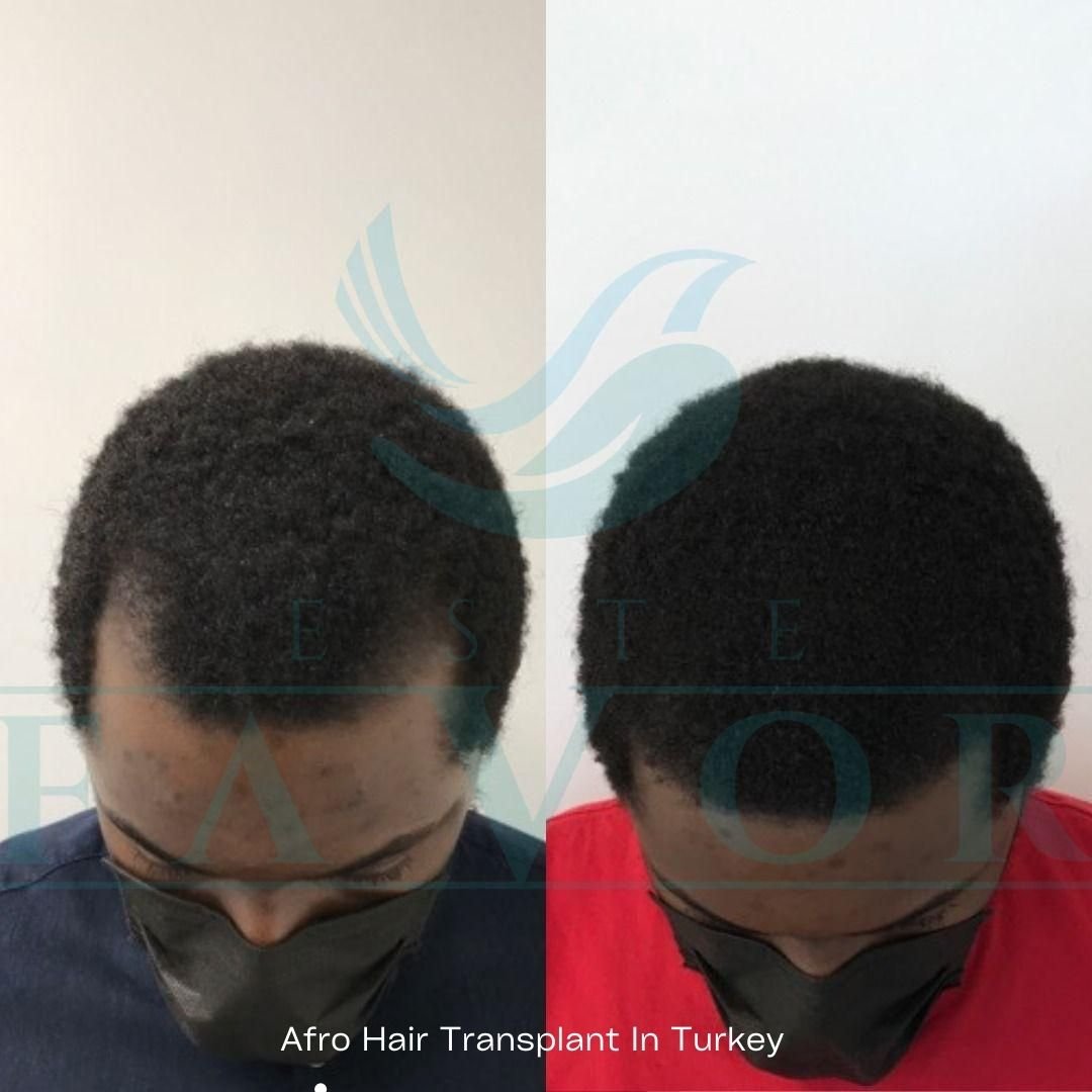 Afro Hair Transplant Estefavor