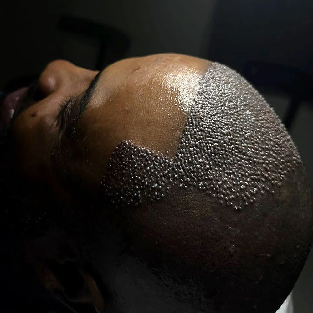 Afro hair transplant in Turkey