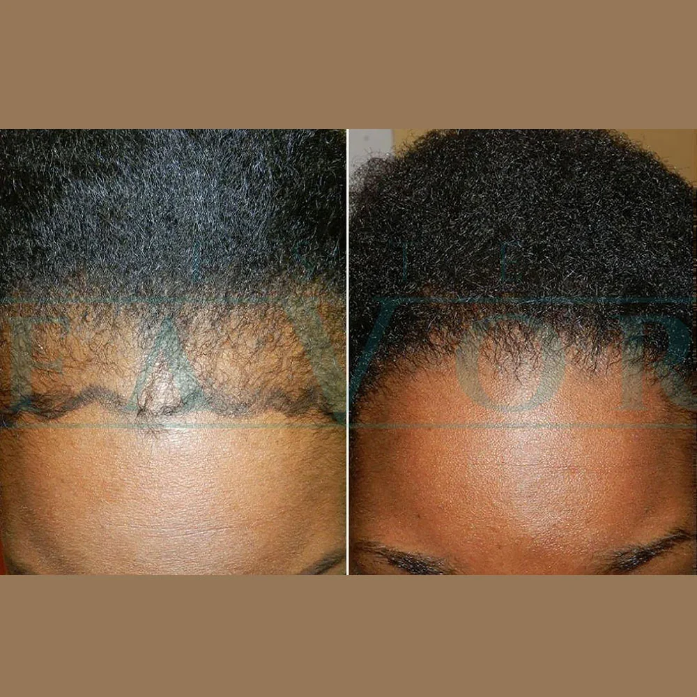 Afro hair transplant in Istanbul
