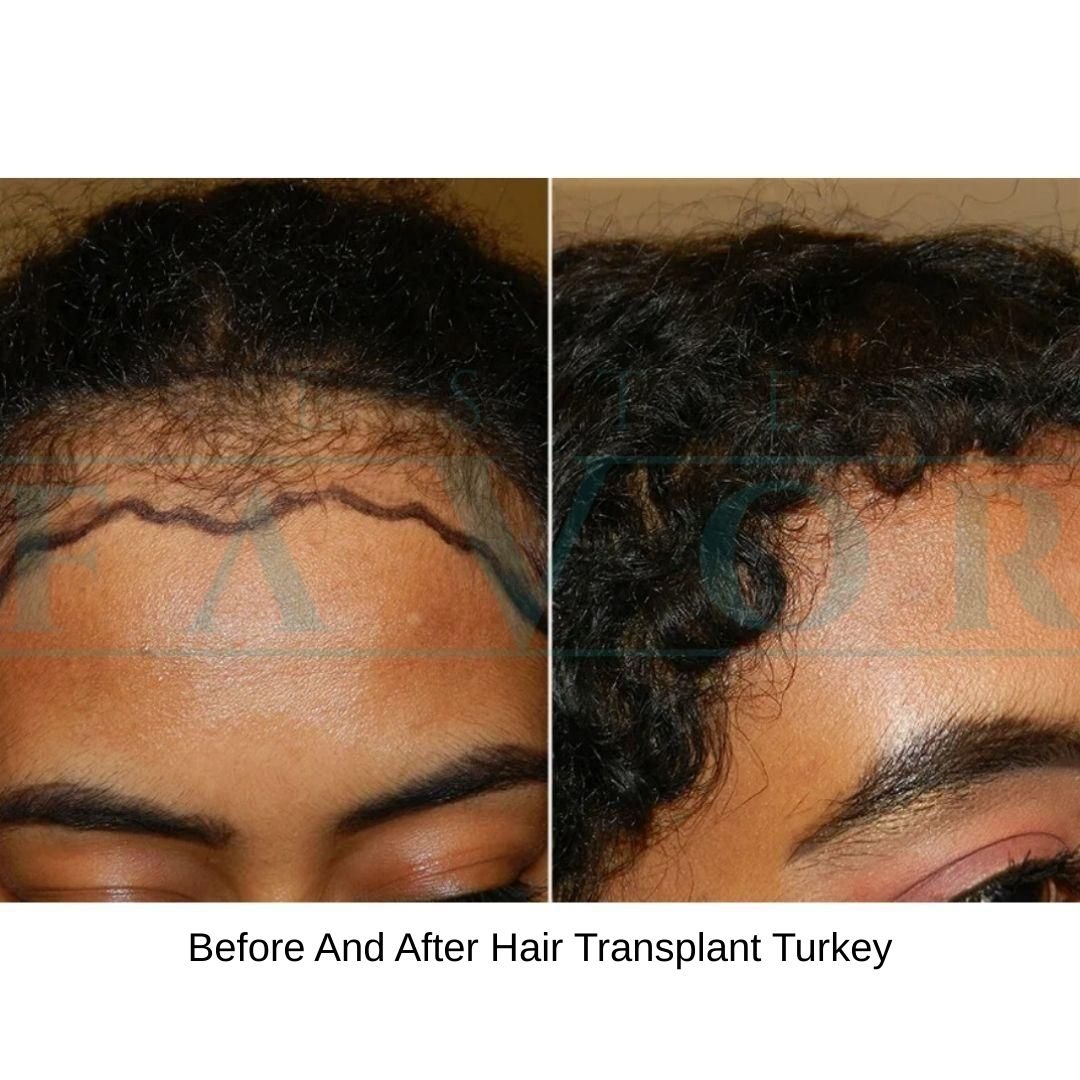 Before And After Hair Transplant Turkey