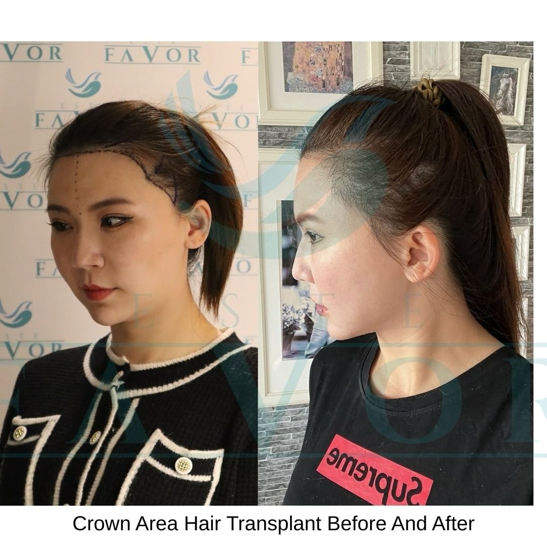 Crown Area Hair Transplant Before And After