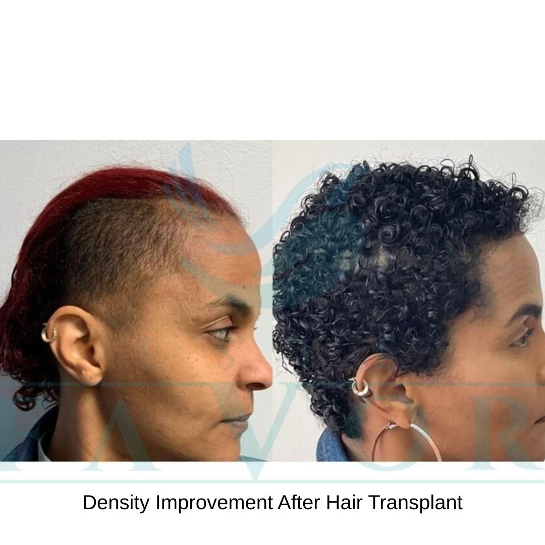 Density Improvement After Hair Transplant