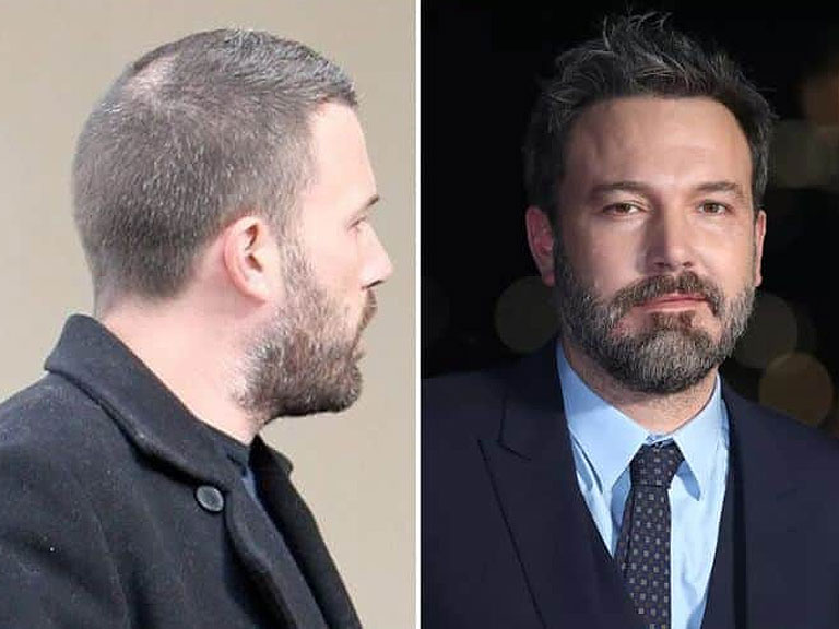 Did Ben Affleck Have a Hair Transplant Operation?