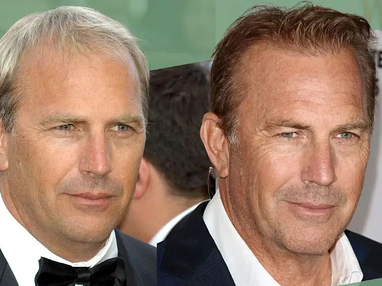 Did Kevin Costner Have a Hair Transplant Operation?