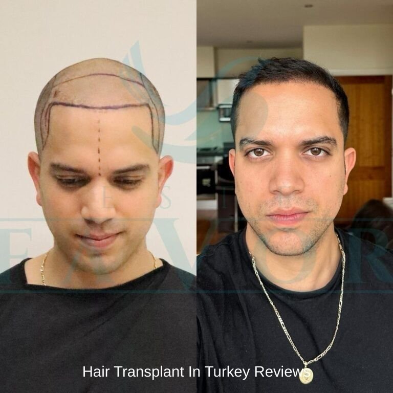 Hair Transplant In Turkey Reviews