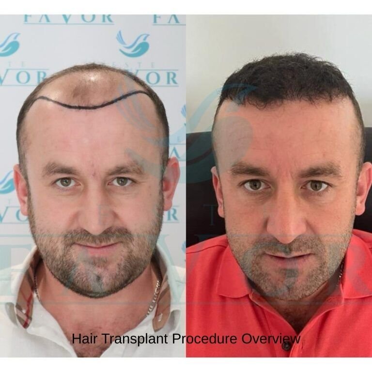 Hair Transplant Procedure Overview