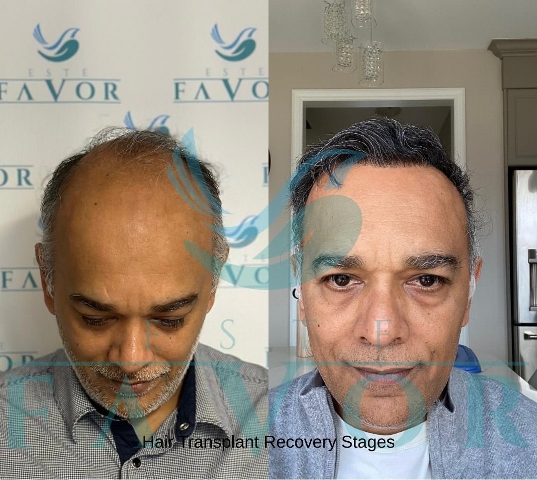 Hair Transplant Recovery Stages