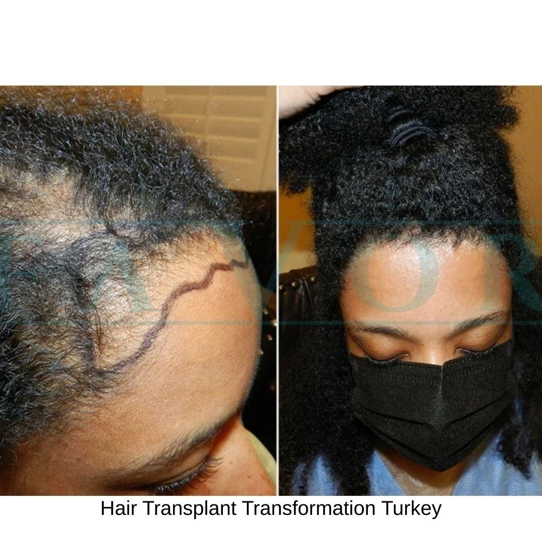 Hair Transplant Transformation Turkey