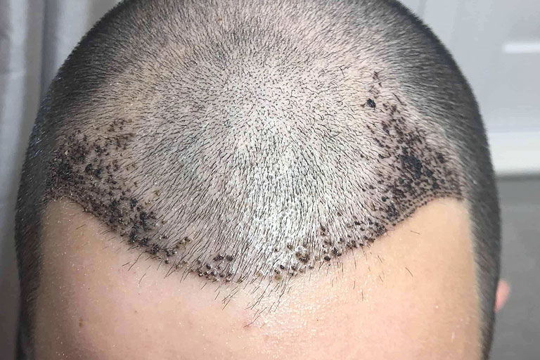 How Can I Get Rid of Hair Transplant Scabs?