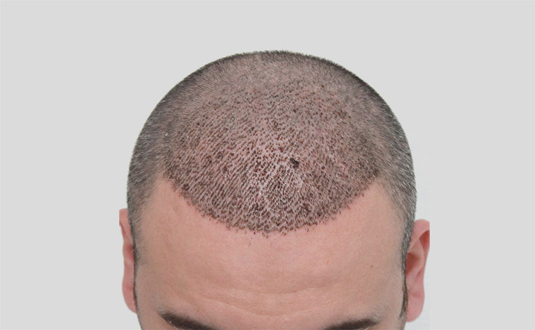 How Many Grafts Are Needed for Hair Transplant?