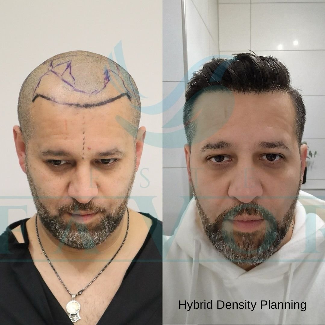 Hybrid Density Planning