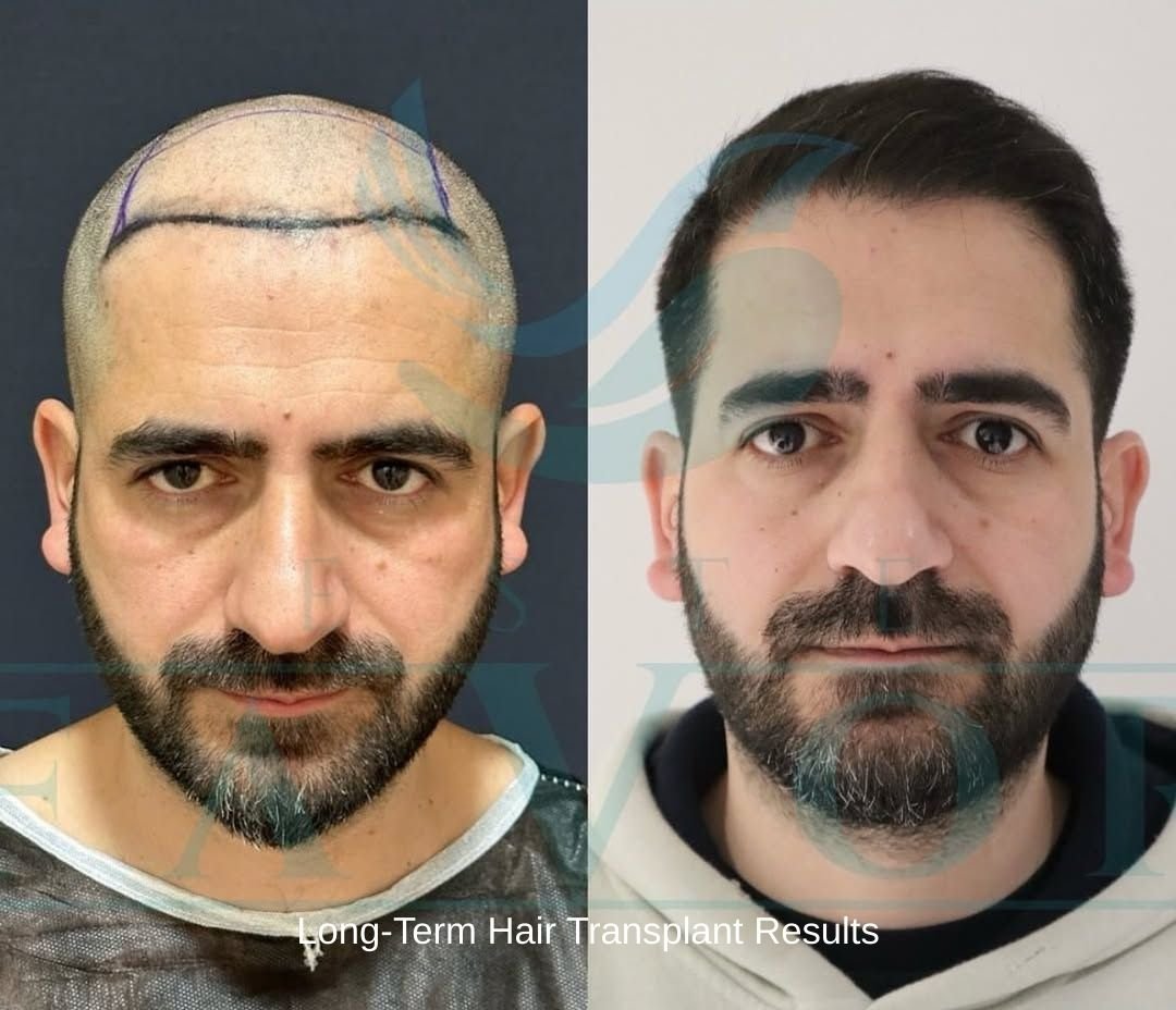 Long Term Hair Transplant Results