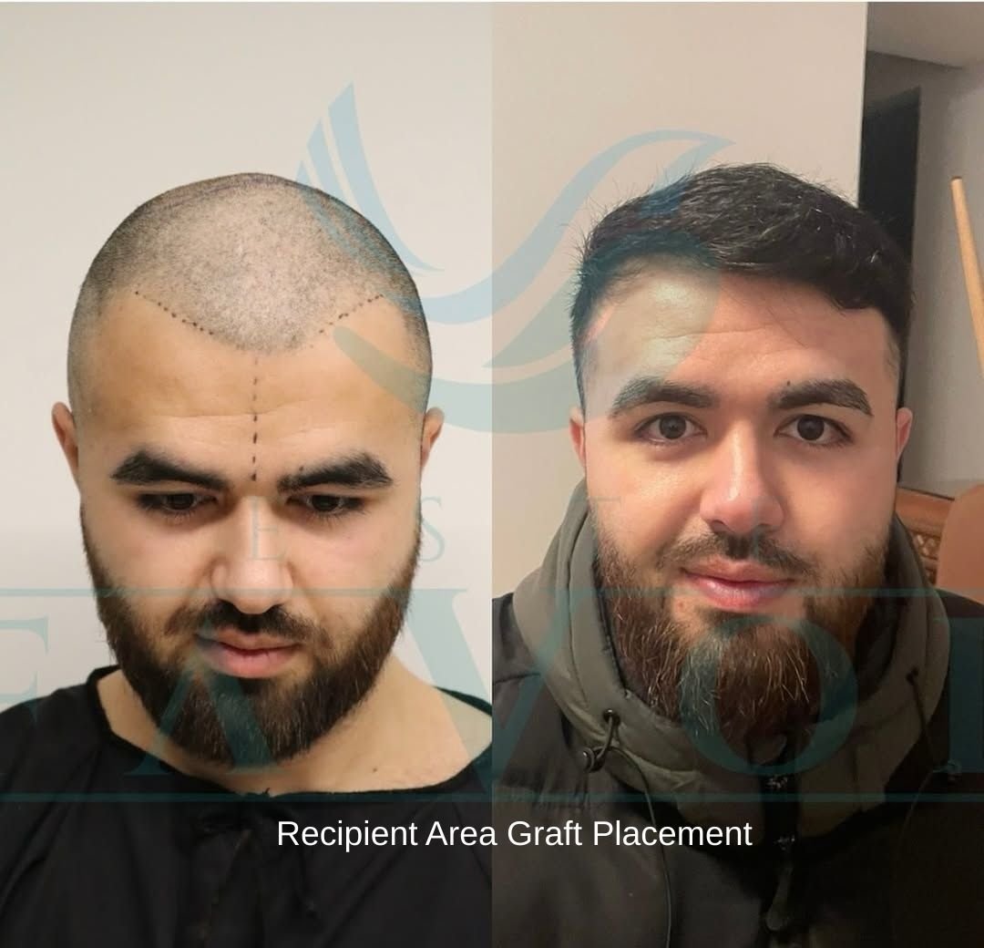 Recipient Area Graft Placement