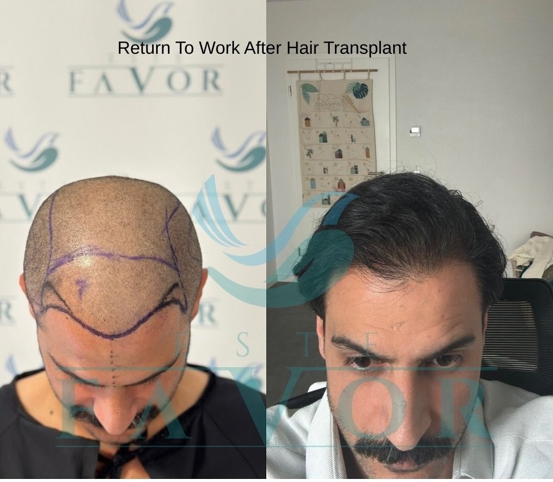Return To Work After Hair Transplant