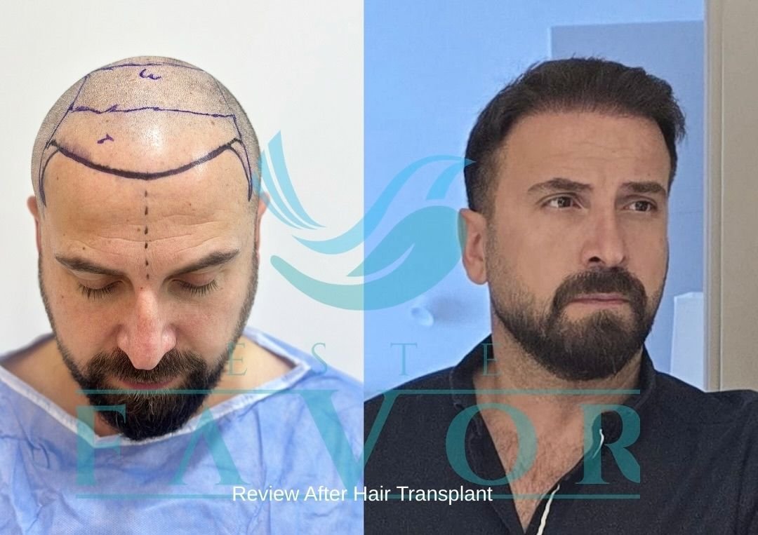 Review After Hair Transplant
