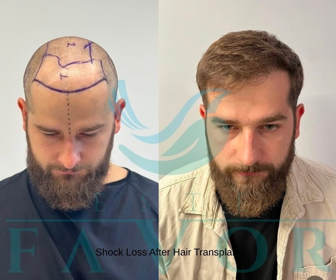 Shock Loss After Hair Transplant