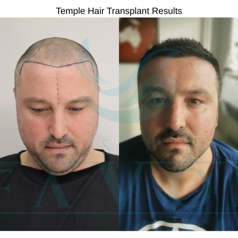 Temple Hair Transplant Results