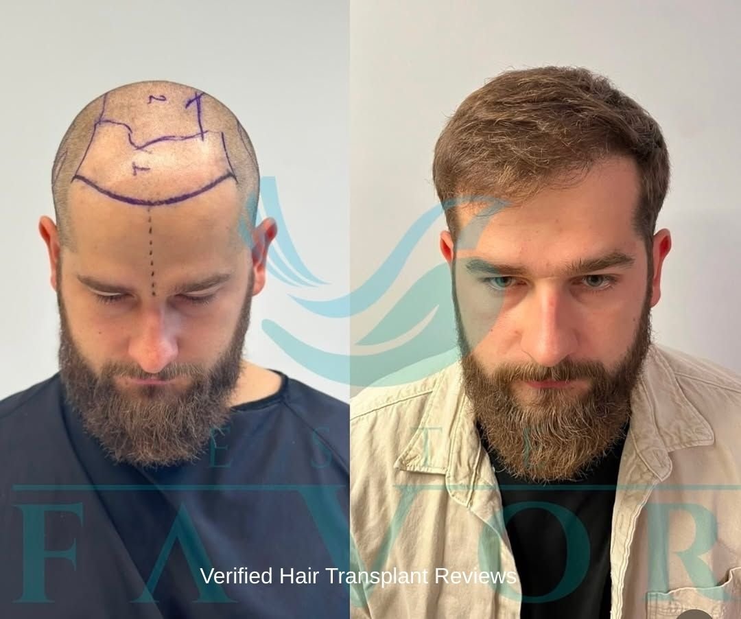 Verified Hair Transplant Reviews