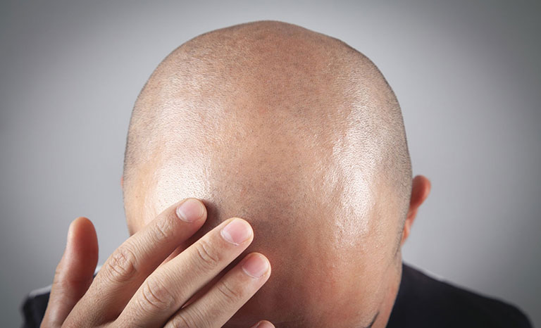 What Is Shaved Hair Transplant?