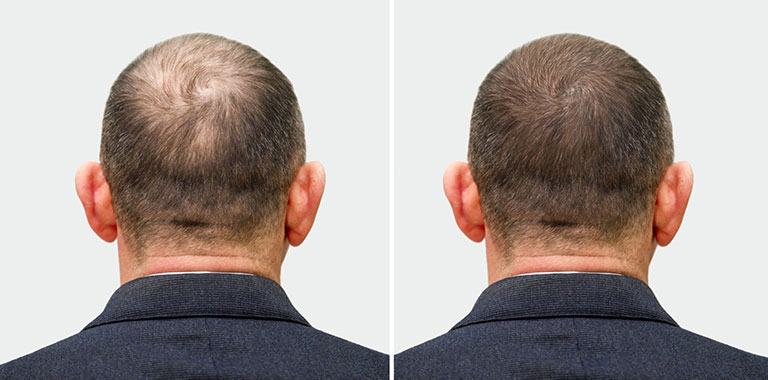 What Is a Hair Transplant?