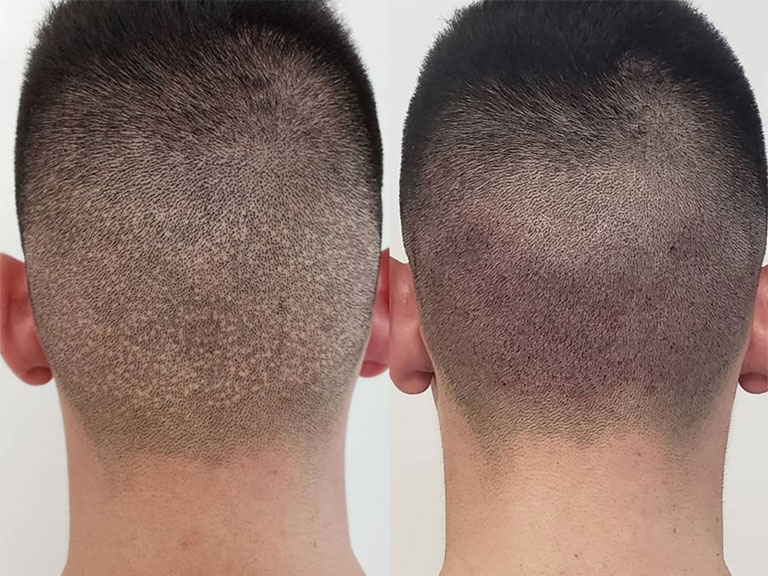 When Do Hair Transplant Scars Recover?