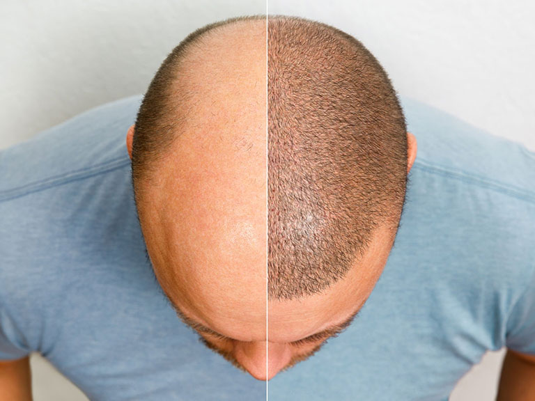 When to Get Hair Transplant Surgery