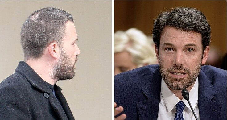 Which Hair Transplant Was Used for Ben Affleck?