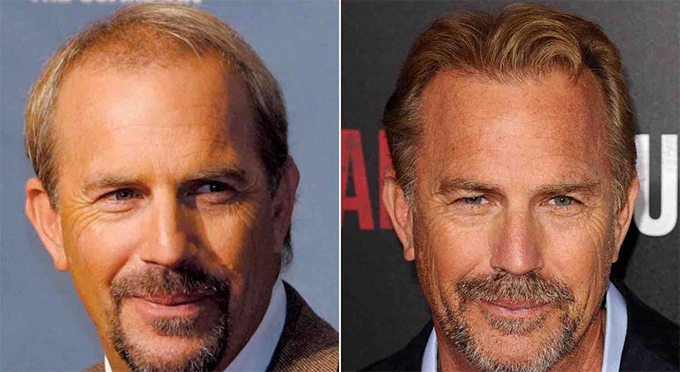 Which Hair Transplant Was Used for Kevin Costner?