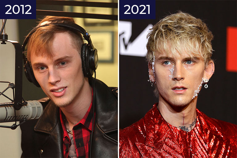 Which Hair Transplant Was Used for Machine Gun Kelly?