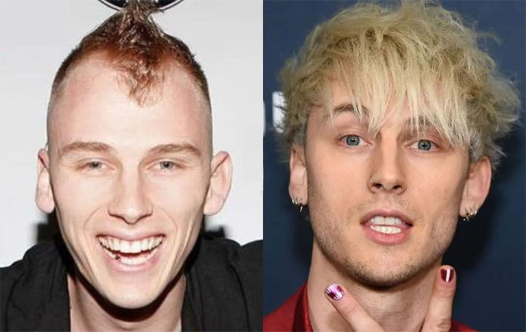 Why Did Celebrities Prefer Hair Transplant?
