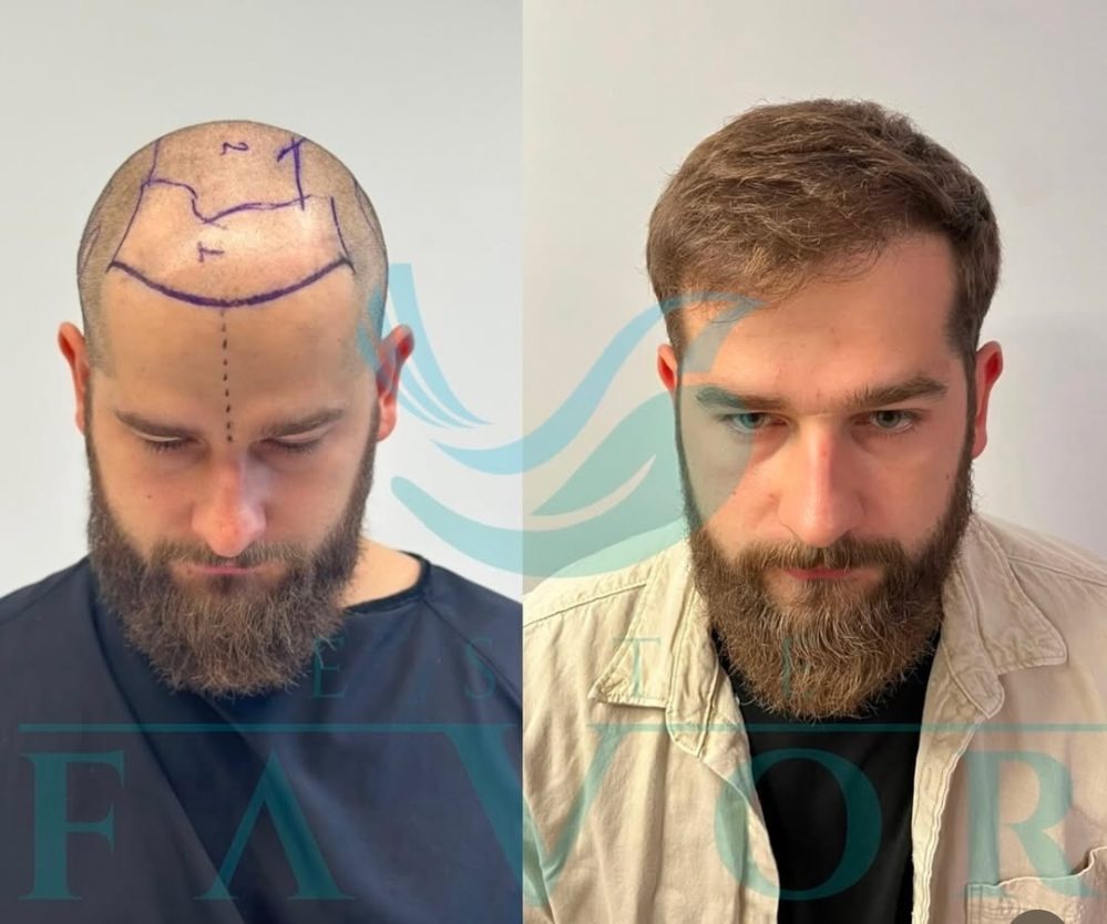Bart und Augenbrauen Transplantation