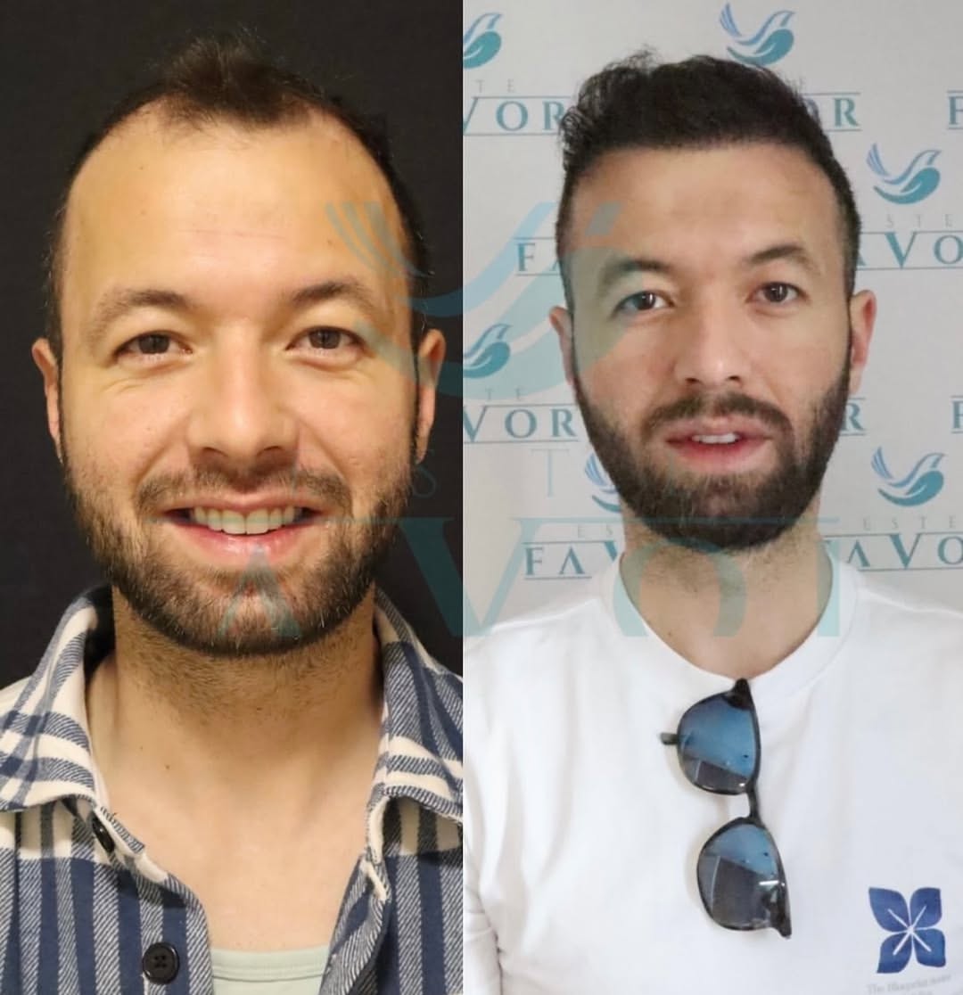 Best Men's Haircuts for Balding Hair