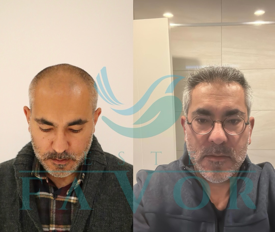 Haartransplantation Kosten 2025: Türkei vs. Deutschland - Der vollständige Preisvergleich