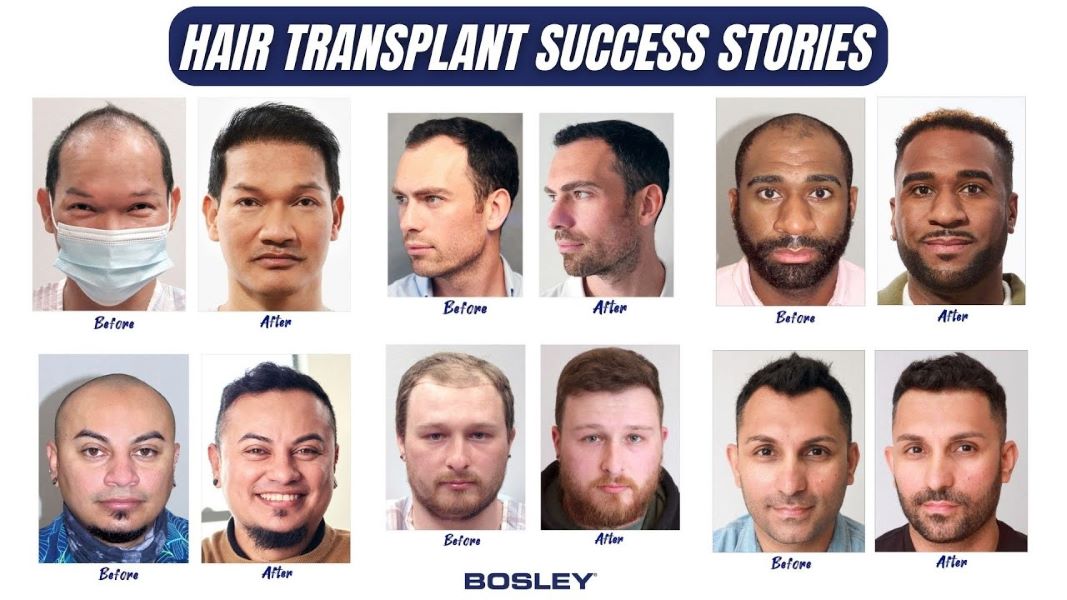 Bosley Hair Transplant Cost: Procedures, Financing, and Global Comparisons