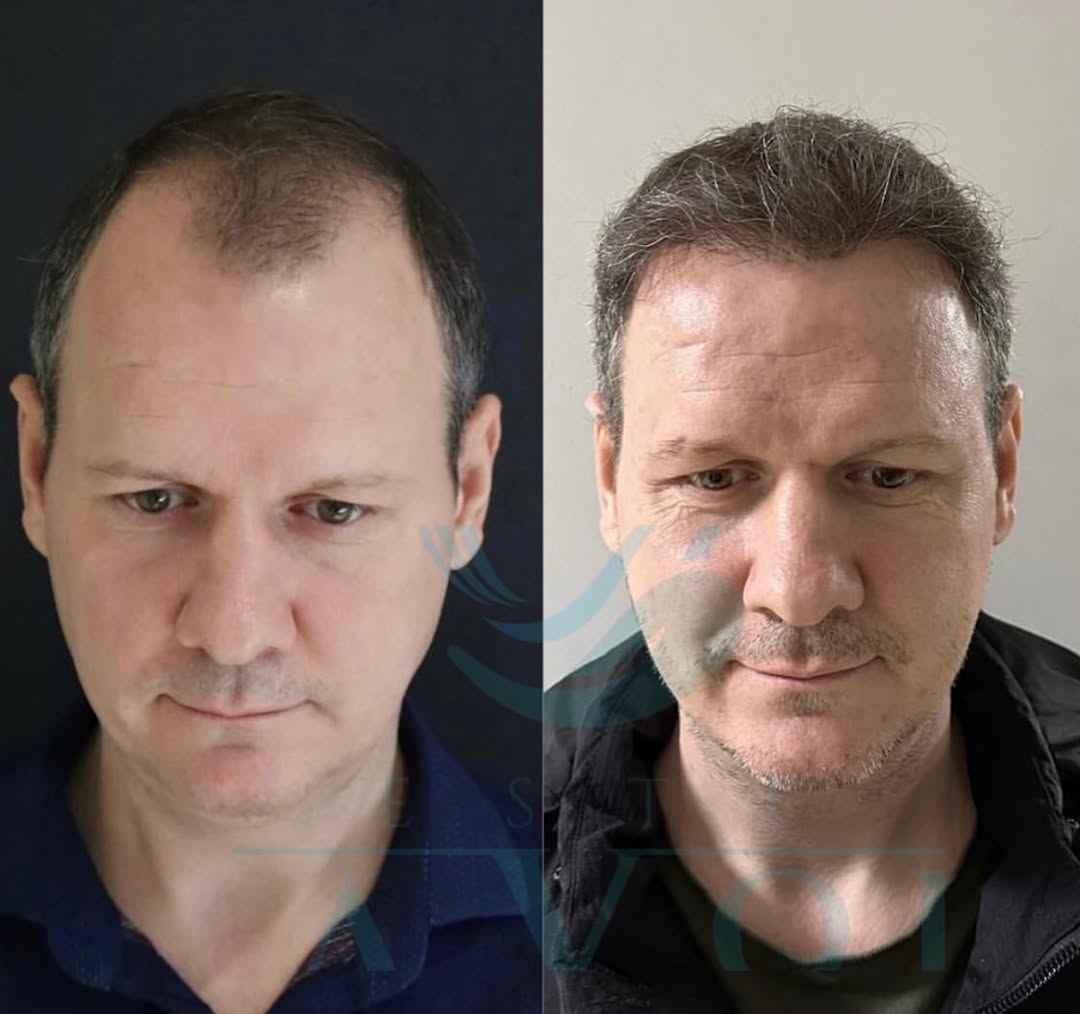 Cause della Caduta dei Capelli: Quando il Trapianto di Capelli è Sensato?