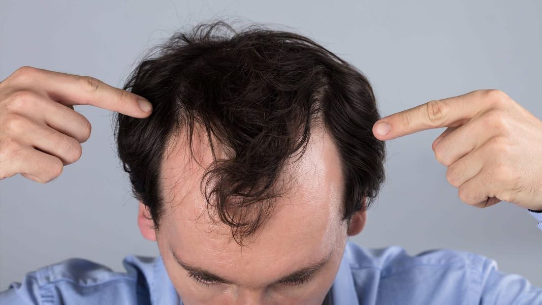 Complete Guide to Hair Graft Costs: FUE vs. FUT Pricing & Cost-Effective Options