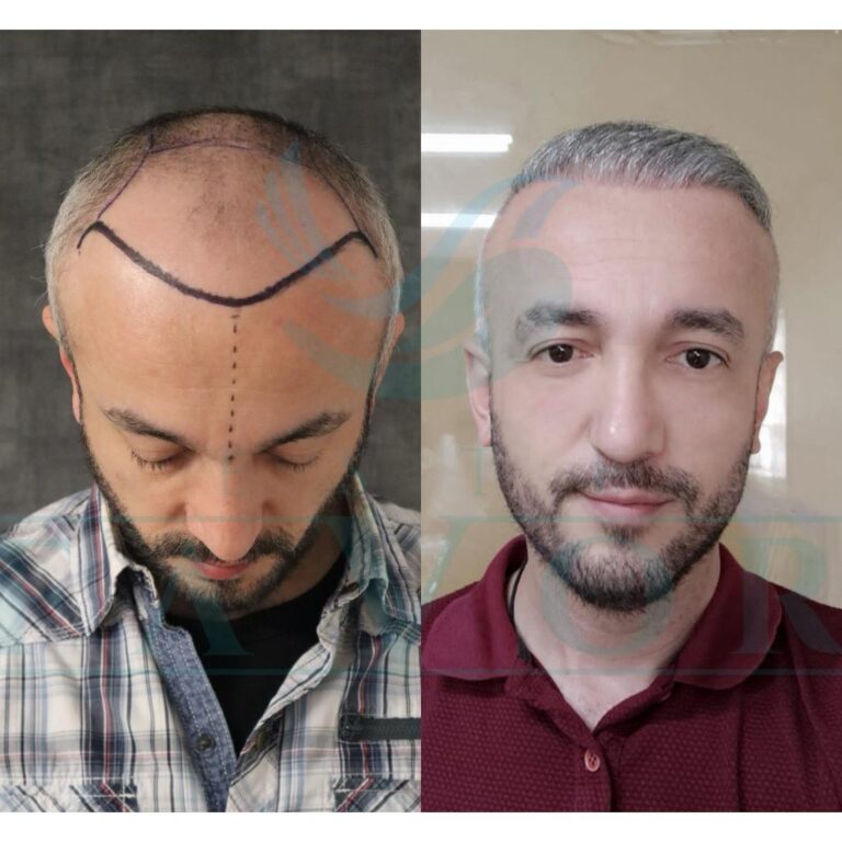 DHI Haartransplantation in der Türkei