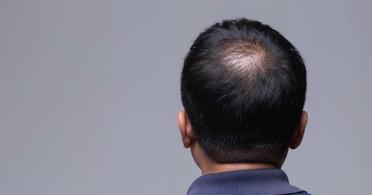 Dihidrotestosterona (DHT): funciones, efectos y control 2025