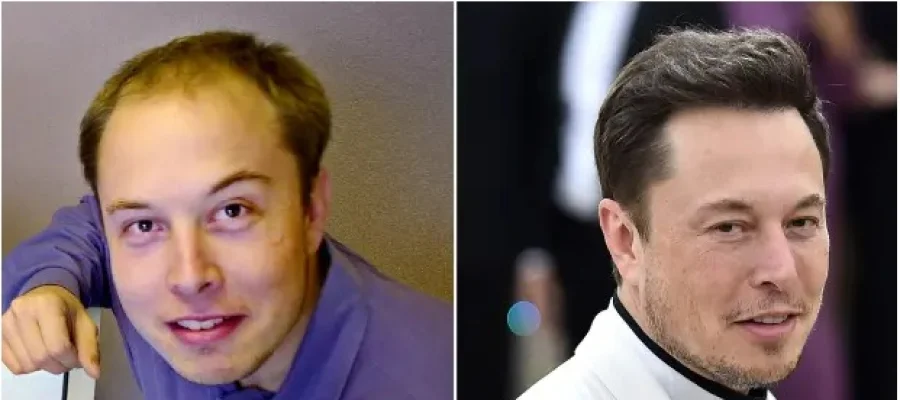 Elon Musk Hair Transplant Technique and Procedure
