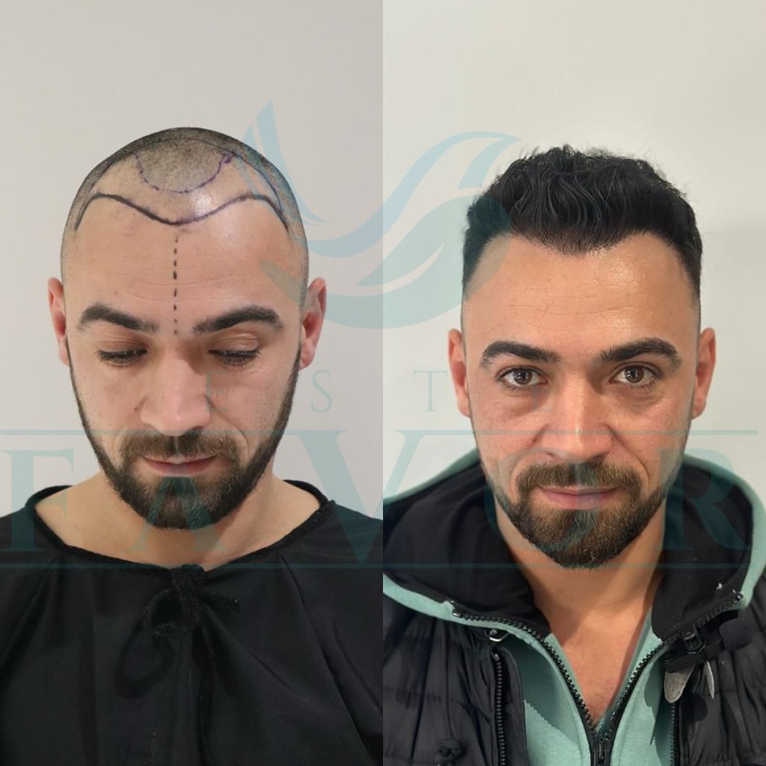 How to Choose the Most Suitable Hair Transplant in Turkey Package: A Comprehensive Guide