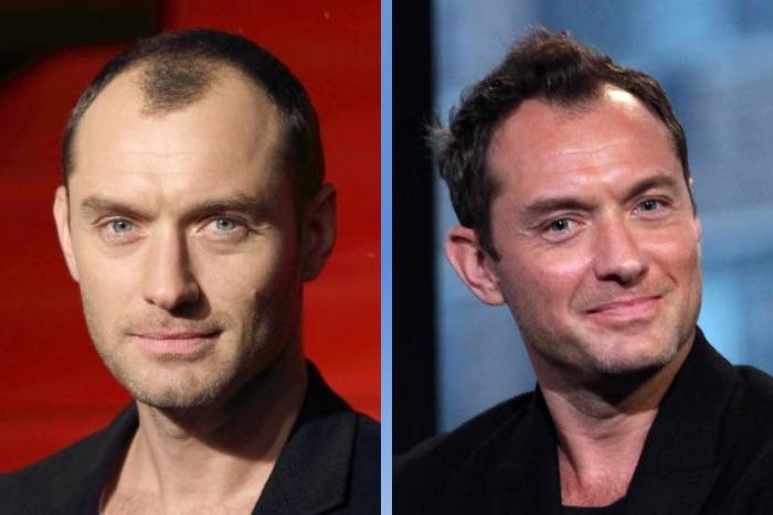 Famous Celebrity Hair Transplants