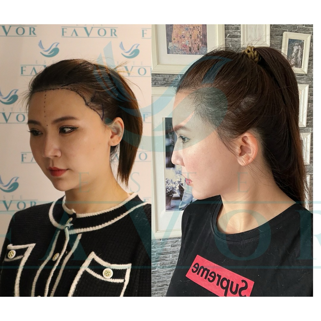 Female Hair Transplant Turkey