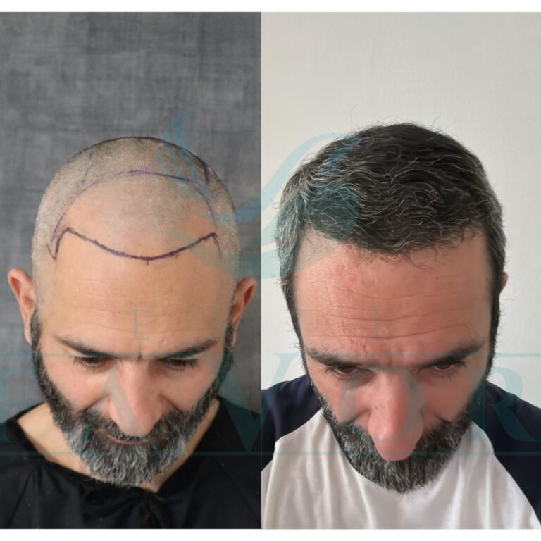 Norwood Skala erklärt: Wie viele Grafts brauchen Sie wirklich für eine erfolgreiche Haartransplantation?