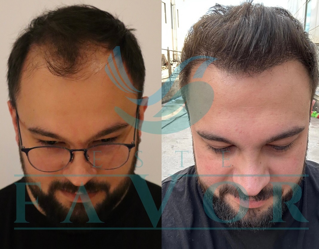 FUE Haartransplantation in der Türkei