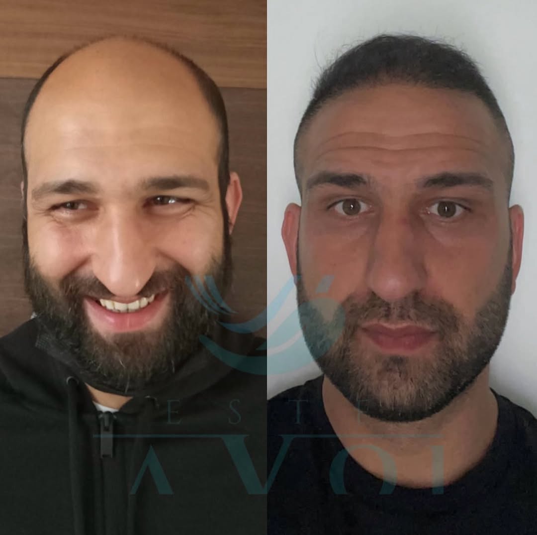 Haartransplantation bei Geheimratsecken