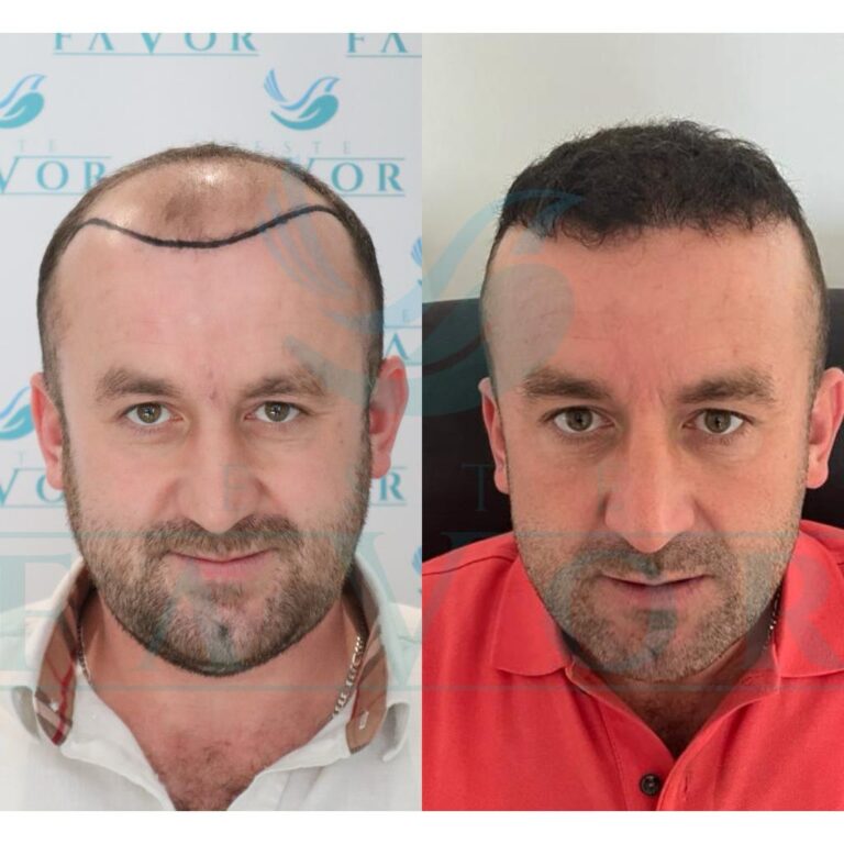 Haartransplantation Ohne Rasur