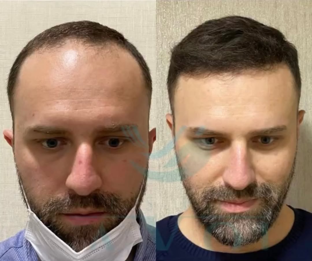 Berlin vs. Istanbul: Warum Tausende Deutsche die Türkei für ihre Haartransplantation wählen