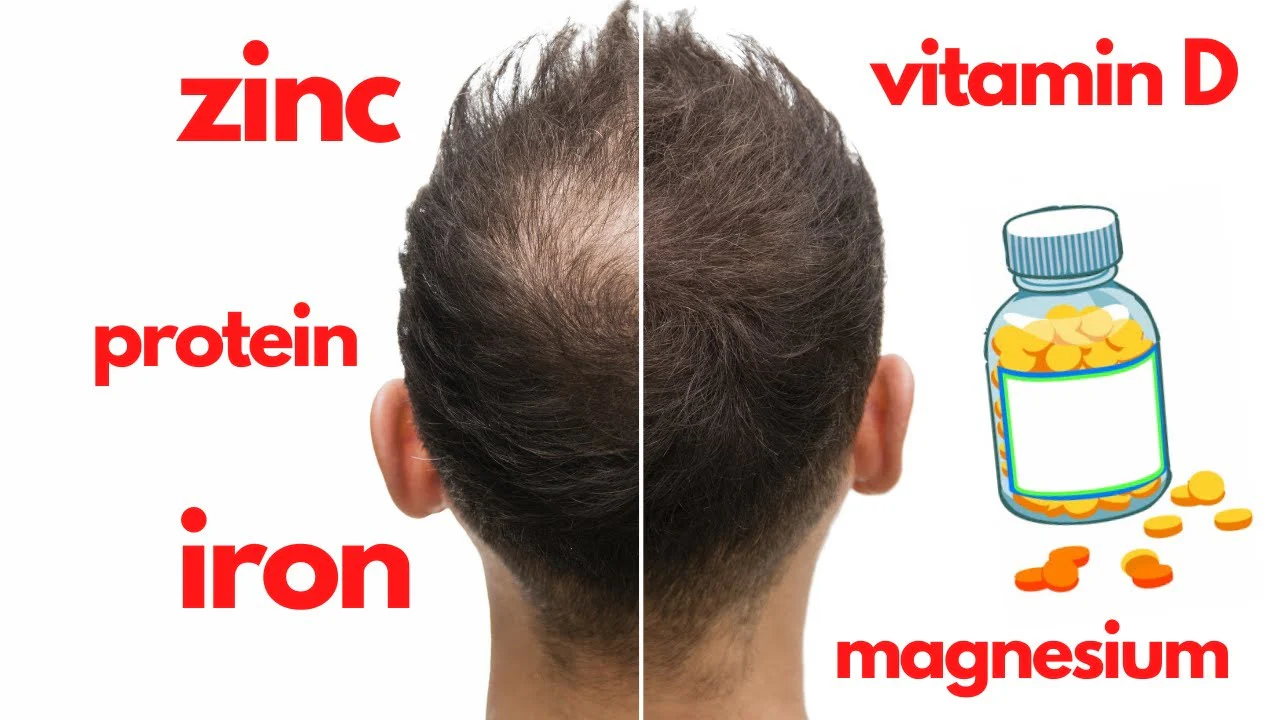 Spironolactone Hair Loss Vitamins Biotin Iron Vitamin D 