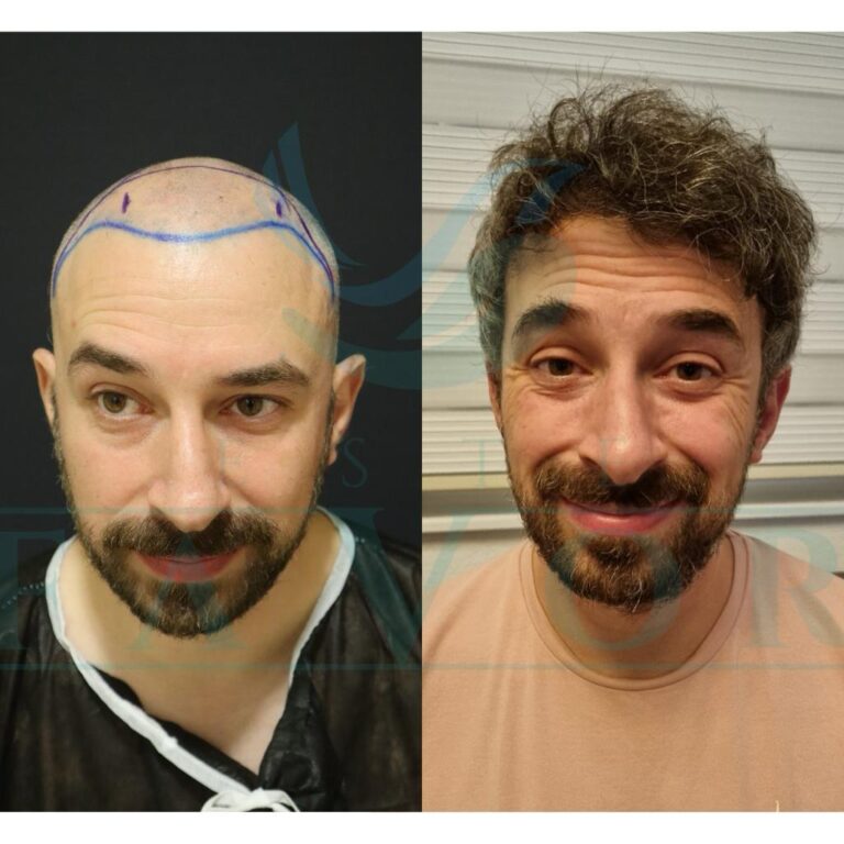 Erfahren Sie alles über moderne Haartransplantation Methoden wie FUE, DHI und Saphir-FUE. Natürliche Ergebnisse, minimale Narben und dauerhafte Haarverdichtung – individuell geplant für Ihr perfektes Erscheinungsbild.